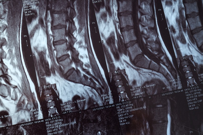 MRI or magnetic resonance imaging of the human spine.